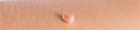 Stielwarzen: Wie äußern sich Fibrome?