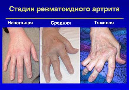 Артрит пальцев рук: причины, симптомы, лечение
