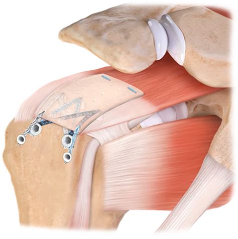 Patch Augmentation in Arthroscopic Rotator Cuff Surgery—Review of
