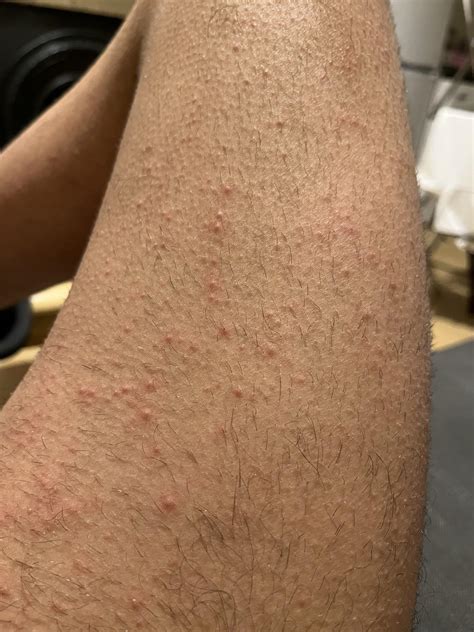 Post Scabies or active? : r/scabies