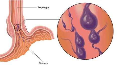 Esophageal Varices Treatment Cost in India