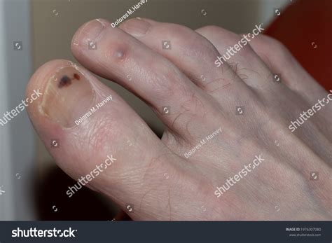 small black spot  toe