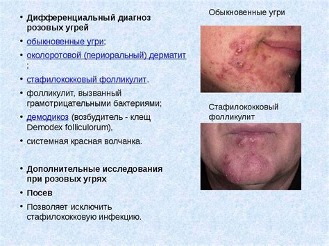 Презентация на тему "Розовые угри (розацеа)" - скачать презентации по ...