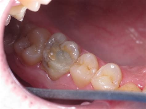 Occlusal surface of the tooth 1.6. | Download Scientific Diagram