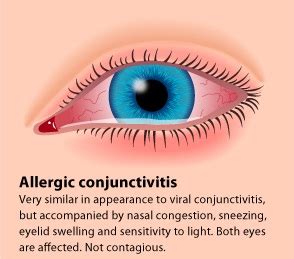 North Houston Eye Care | Eye Allergies