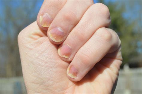 understanding nail health  common nail problems dermatology