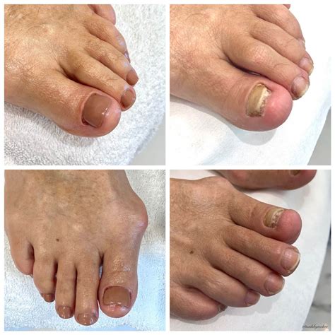Nail Reconstruction Treatment | Nails by Toe Bro