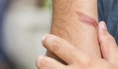 ways  treat minor burns naturally