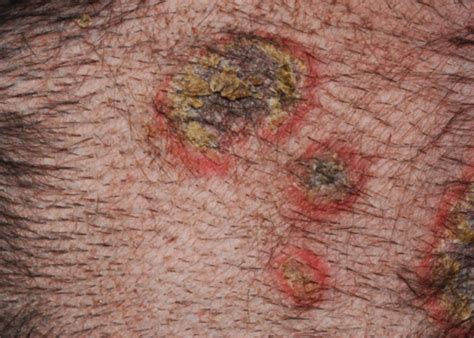 derm   pyoderma flashcards quizlet