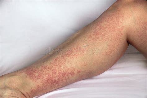 allergic reaction stock    royalty