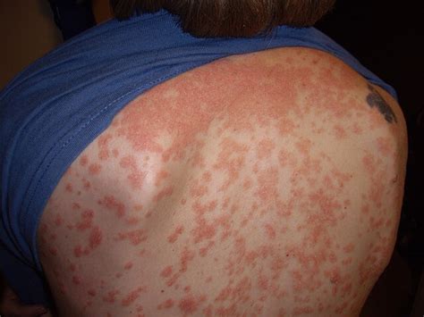 Guttate psoriasis - Wikipedia