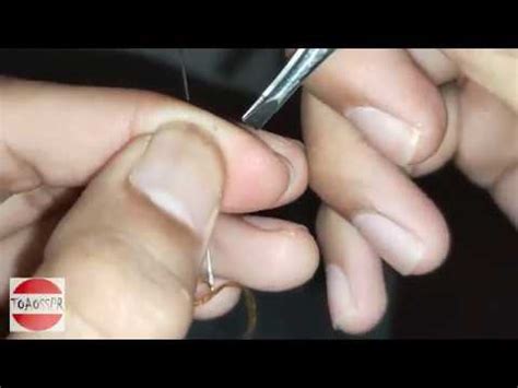 Hair Splinter Removal!!! - YouTube