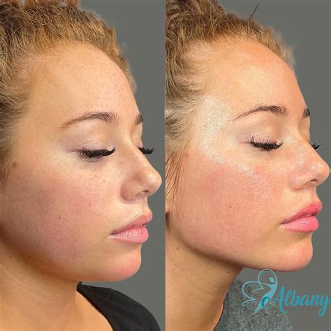 do fillers ruin your face 5