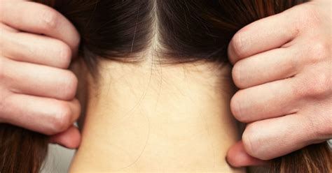 Hair Falling Out - Expert Advice To Treat Hair Loss