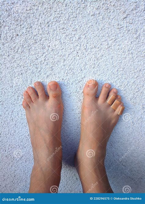 Woman`s Legs with a Plasters To a Callus on Toes. Foot Skin Care and