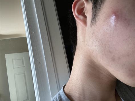 [skin concern] this huge pimple is painful to touch and seems to be