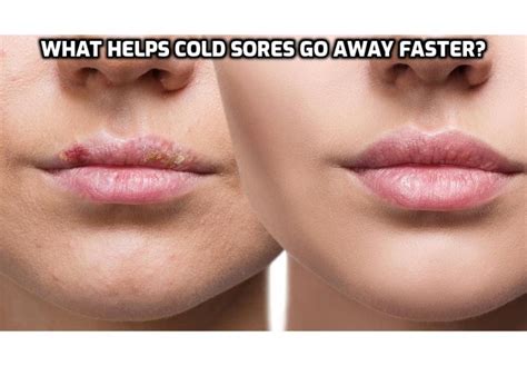 Natural Cold Sores Treatment – What Helps Cold Sores Go Away Faster? – Anti-Aging, Beauty ...