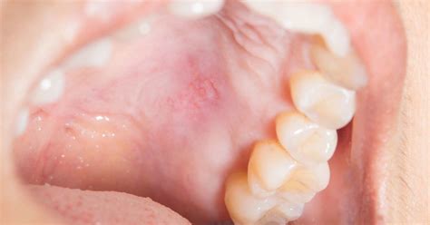 Small Red Spots On Roof Of Mouth Child - Infoupdate.org
