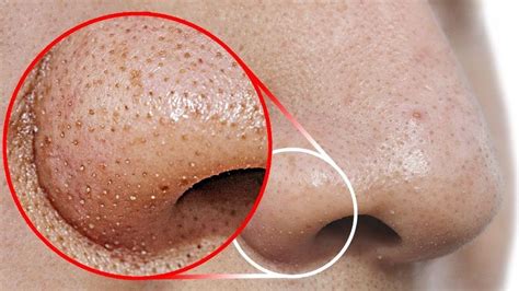 Unbelievable Blackhead Removal 2024: Say Goodbye to Pores! - hb5rhtc