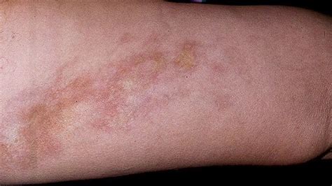 esclerodermia localizada  morfea canarias dermatologica