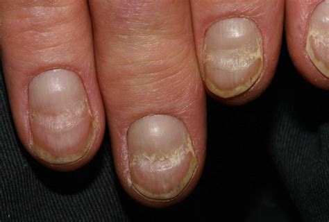 Iron Deficiency Anemia Nails