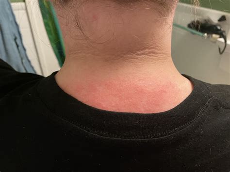 Hives on arm and neck : r/skin
