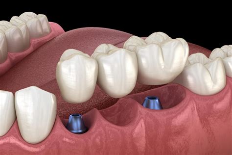 Dental Implant Supported Bridges » Dentist in Stoke-on-Trent » Newcastle Dental & Implant Clinic