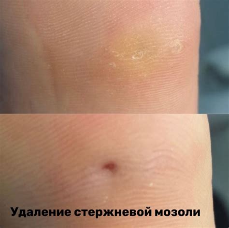 Стержневая мозоль: причины появления | Leo Beauty | Центр Подологии ...