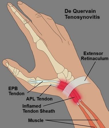 de quervain tenosynovitis  treatment  mommy thumb