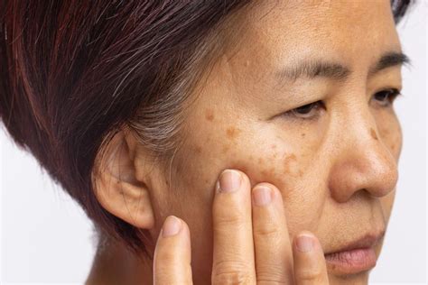 melasma  hyperpigmentation  triggers treatments  key