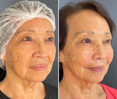 Radiesse Rosto Antes E Depois - Radiesse: Antes e depois