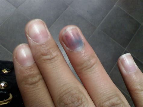 fingernails melanoma - pictures, photos