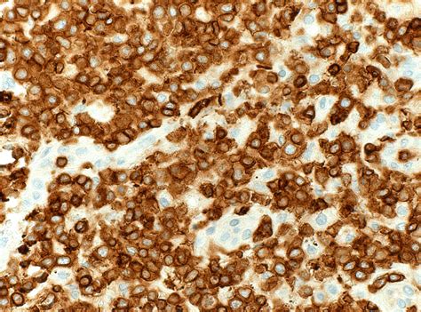 pathology outlines cd