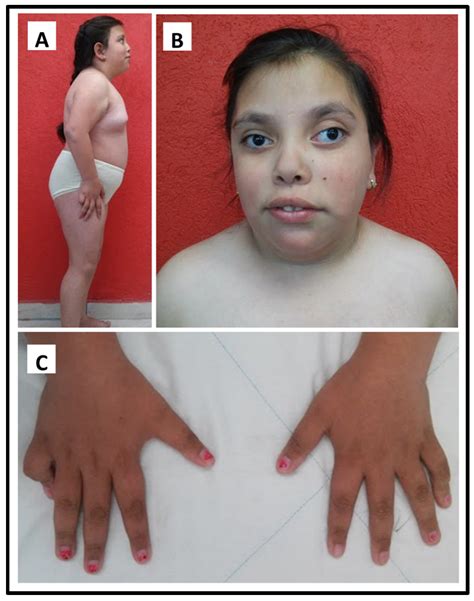 Monosomy Turner Syndrome