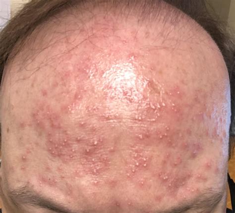Flare Ups After Working in Heat. : r/Rosacea