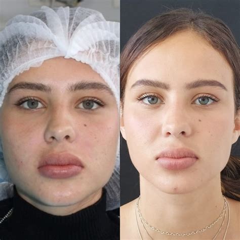 Antes E Depois Bichectomia - Bichectomia: Antes e depois – Antes da Fama