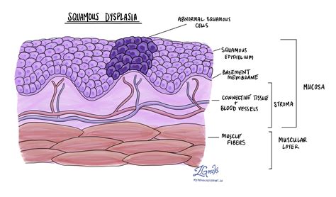 Squamous dysplasia of the oral cavity - MyPathologyReport.ca