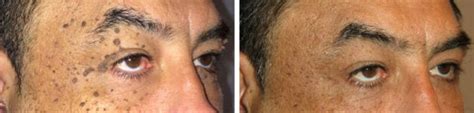 Eye Lid Skin Tag Removal London | Skin Tag Removal Near Eye ...