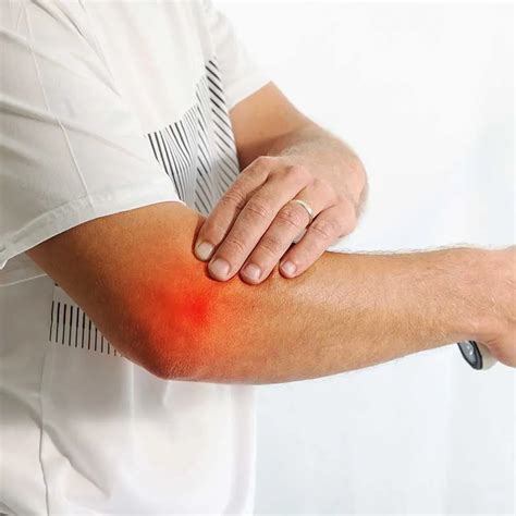 Olecranon Bursitis: Causes, Symptoms and Treatments