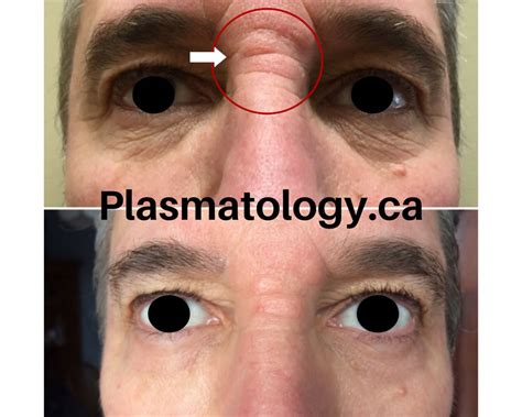 Keloids and Hypertrophic Scars - Plasmatology Group Inc. Canada