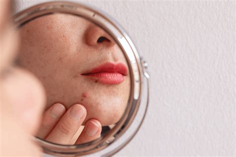 how to get rid of pimples around mouth