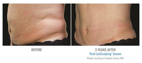 CoolSculpting Love Handles Woman Before and After Photos