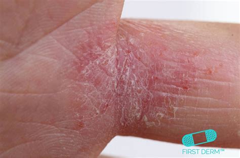 Medicine For Itchy Skin Rash - MedicineWalls