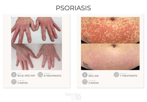 Dermalux Flex MD - CDP SWISS AG