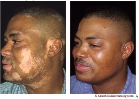Mama-cadela Vitiligo Antes E Depois - Mama Cadela para Vitiligo: funciona mesmo? Conheça essa planta!