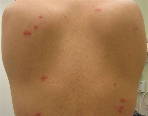 Can Dust Mites Leave Bite Marks at Alana Walden blog