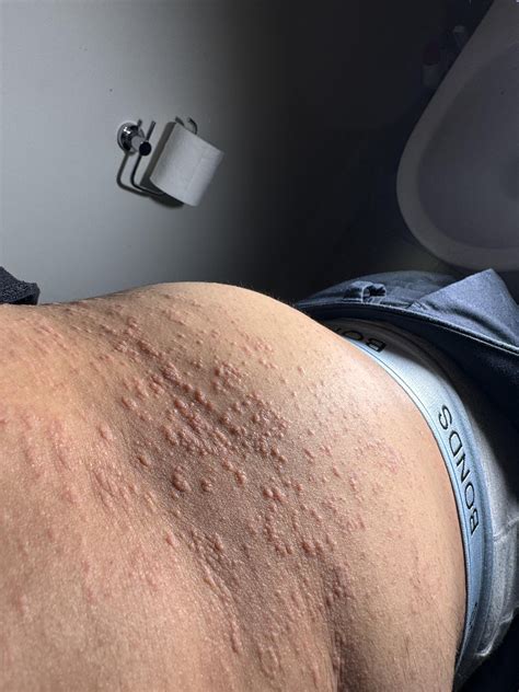 Does is look like Pityriasis rosea ? I have seen my dermatologist and