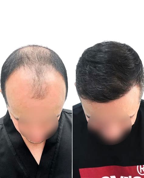 fue in hair transplant 2