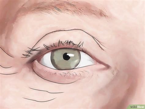 How to Know if You Have Eye Mites: Symptoms & Treatments