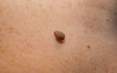 prevent skin tags